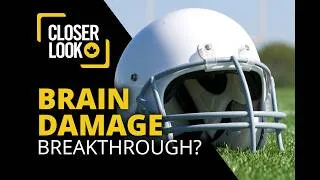 Thumbnail: The Brain Disease That Can Only Be Diagnosed After Death Until Now