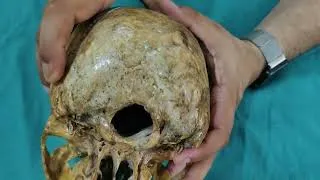 Thumbnail: Osteology of Skull ( norma occipitalis)