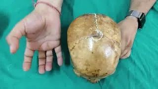 Thumbnail: Osteology of Skull ( norma verticalis )