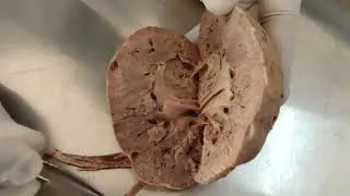 Thumbnail: Kidney (macroscopic features)