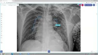 Thumbnail: Cardiogenic Shock