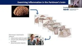 Thumbnail: Targeting inflammation in Parkinson’s: an update on two phase 2 trials – Dr Caroline Williams-Gray
