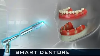 Thumbnail: SMART implant-supported Denture (Full Mouth) l Curveia Dental Animation