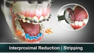 Thumbnail: Interproximal Reduction (IPR) | Stripping | Orthodontic Treatment | Curveia Dental Animation