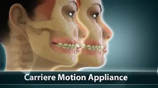 Thumbnail: Carriere Motion Orthodontic Treatment | Curveia Dental Animation | Patient Education Video