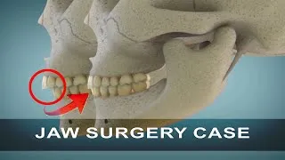 Thumbnail: Corrective Jaw Surgery | Orthognathic Surgery | Curveia Dental Animation