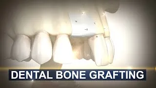 Thumbnail: Bone Grafting for Dental Implants in 3D Animation | Maxillofacial & Dental Implant Surgery
