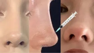 Thumbnail: INSTANT NOSE REDUCTION + TINY NOSE MORPH 💉overforced formula ౨ৎ 