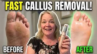 Thumbnail: Electric Callus Remover | Two Heads, Two Speeds, Smooth Results!