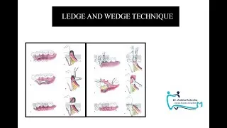 Thumbnail: PALATAL FLAPS| MODIFIED PARTIAL THICKNESS PALATAL FLAPS| LEDGE AND WEDGE TECHNIQUE| DR. ANKITA