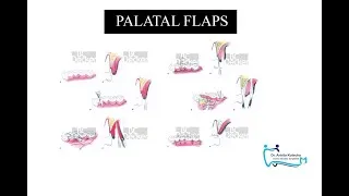 Thumbnail: PALATAL FLAPS| PARTIAL THICKNESS PALATAL FLAPS | DR. ANKITA KOTECHA | DENTAL STUDIES SIMPLIFIED