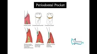 Thumbnail: PERIODONTAL POCKET| TERMINOLOGIES| CLASSIFICATION| FEATURES| SITE SPECIFICITY| HEALING LESION