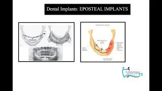 Thumbnail: 4. EPOSTEAL IMPLANTS| TYPES OF DENTAL IMPLANTS| DR. ANKITA KOTECHA| DENTAL STUDIES SIMPLIFIED
