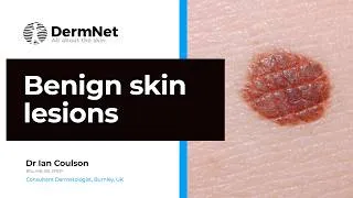 Thumbnail: Benign skin lesions