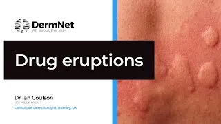 Thumbnail: Understanding Drug Eruptions