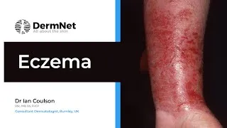 Thumbnail: Eczema: A Complete Overview