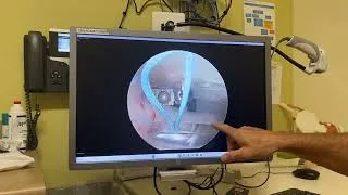 Thumbnail: My rotator cuff injury / shoulder surgery repair
