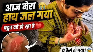 Thumbnail: Aaj Mera Hath Jal Gaya 😢🔥 | Painful Day Vlog | Daily Vlog India | #vlog #dailylifevlog