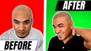 Thumbnail: 🌟 How SMP Restored My Hairline 🤩Instant Hair Loss Solution in Just 3 Visits!