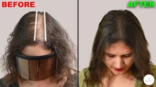 Thumbnail: Scalp Micropigmentation for Alopecia | Best Hair Loss Decision & Natural Results