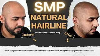 Thumbnail: ⭐SMP Gave Me A Natural Hairline No More Hair Loss | Non-Surgical Treatment #smp  #hairgrowth