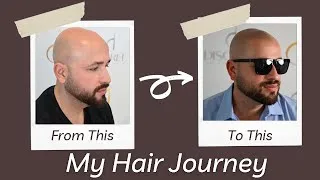 Thumbnail: Why I Chose Scalp Micropigmentation | My Hair Loss Story & Non-Surgical Transformation