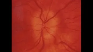 Thumbnail: Idiopathic intracranial hypertension- a diagnosis not to miss
