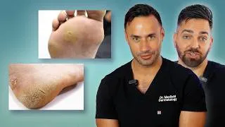 Thumbnail: The ULTIMATE Guide to Foot Care | Cracked Heels, Fungus, Corns, Warts & More