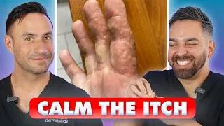 Thumbnail: ITCHY FINGERS? Dyshidrotic Eczema: Causes, Treatment, and Prevention