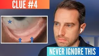 Thumbnail: AI reveals 10 clues of early colon cancer