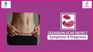 Thumbnail: Why your C-Section scar might be causing pelvic pain & bleeding? With Gynaecologist Dr Veenu Agarwal