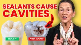 Thumbnail: Parents Should REFUSE Sealants - The Hidden Problems