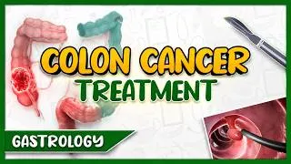 Thumbnail: Colon Cancer Management Explained Easily: Treatment, Follow-Up Care and Screening,
