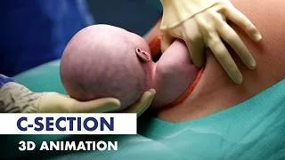 Thumbnail: What to expect during a C-section | 3D Animation