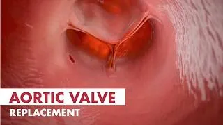 Thumbnail: Aortic Valve Implementation (TAVI) | 3D Animation