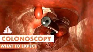 Thumbnail: What Happens During a Colonoscopy? | 3D animation