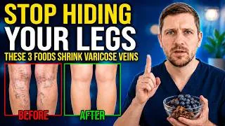 Thumbnail: Horse Chestnut vs Compression Stockings? The Science Might Surprise You