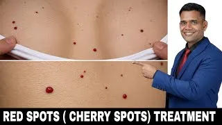 Thumbnail: Red Spots on Skin? Remove Cherry Angiomas Naturally | Causes & Treatment