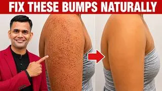 Thumbnail: Get Rid Of Red Bumps on skin  | Bumps on the skin treatment/ Follicular keratosis treatment