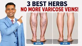 Thumbnail: 3 Best Herbs for Varicose Veins | Improve Leg Circulation Naturally