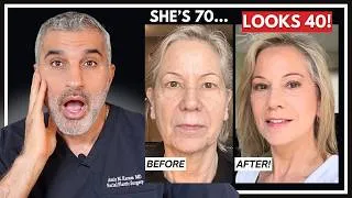 Thumbnail: 69 Years Old & Viral: Why People Think This Facelift Is Faked (It’s Not)