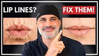 Thumbnail: Lip Lines Treatments - How a Facial Plastic Surgeon Fixes Upper Lip Wrinkles