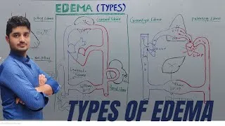 Thumbnail: Types of Edema / causes/pulmonary, anasarca, cerebral, pitting, non pitting edema