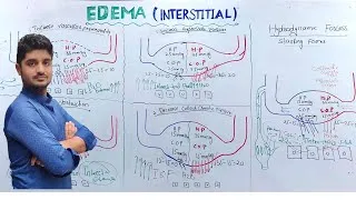 Thumbnail: Interstitial Edema Pathology / Edema part 3