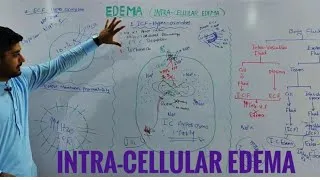 Thumbnail: Intracellular edema pathophysiology/edema part 2