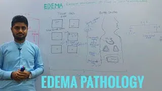 Thumbnail: Edema/Oedema/Edema pathology/introduction to edema