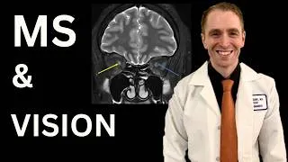 Thumbnail: Multiple Sclerosis Visual Symptoms