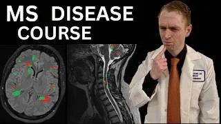 Thumbnail: Multiple Sclerosis Progression and Pathophysiology "Chalk Talk" by a Neurologist