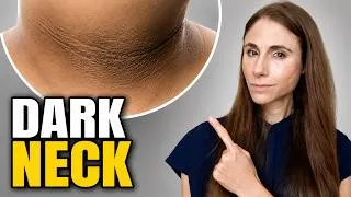 Thumbnail: Dark Neck? It Could Be Acanthosis Nigricans | Dermatologist Explains