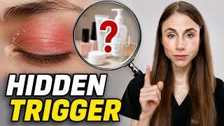 Thumbnail: Eyelid Dermatitis: The REAL Cause (It's Often Not Your Eye Cream)